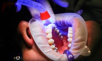 Dlaczego implanty stomatologiczne są tak cennym zabiegiem stomatologicznym?